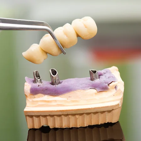 A dental bridge being installed on a model gumline