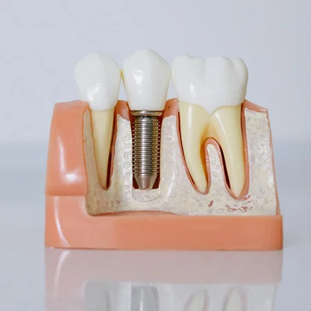 A model showing a dental implant between two natural teeth