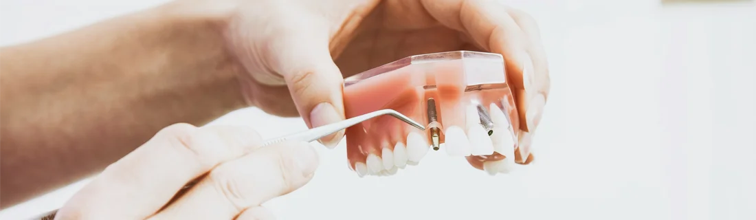 FC – Dental Implants at Encino Cosmetic & Dental Implants in Encino CA