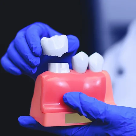 A model of a dental crown being placed on a tooth