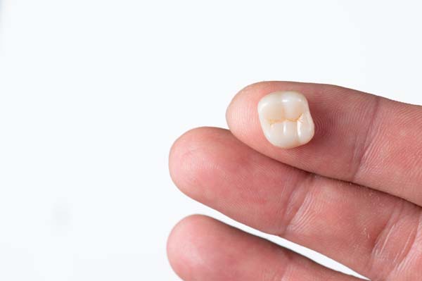 CEREC Single Visit Dentistry — No Need For A Temporary Crown