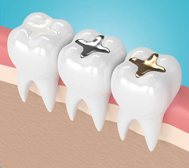 Encino Composite Fillings