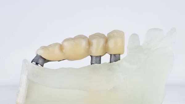 How Many Teeth Can Dental Bridges Replace?