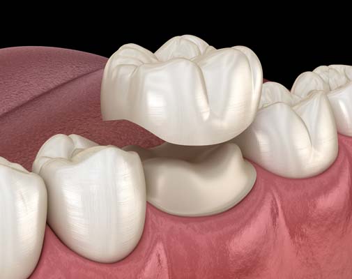 What Is A Dental Crown Restoration?