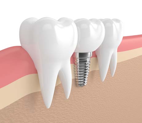 Can Dental Implants Replace Front Teeth?