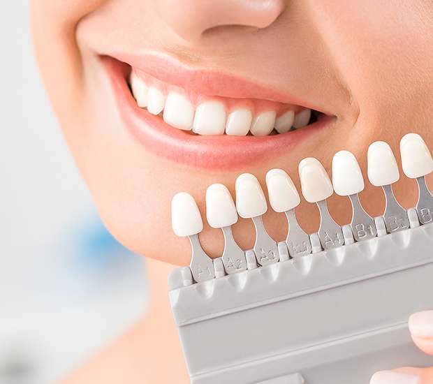 Encino Dental Veneers and Dental Laminates