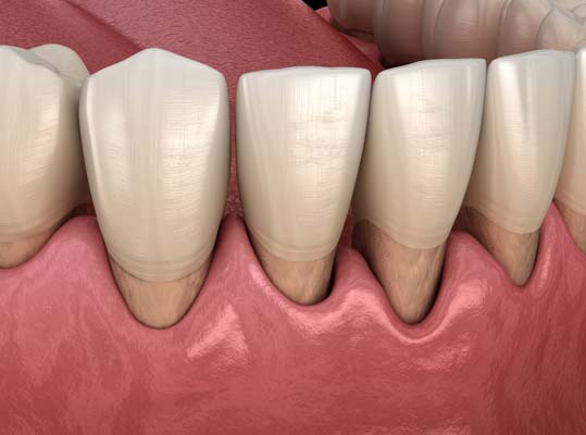 Treatment Options For Gum Recession