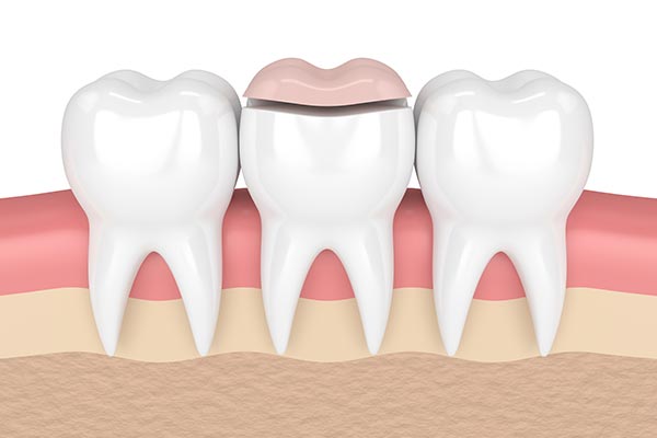 How a Cosmetic Dentist Can Place Inlays and Onlays from Encino Cosmetic & Dental Implants in Encino, CA