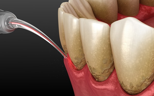 Laser Dentistry: An Alternative To Traditional Dental Treatment