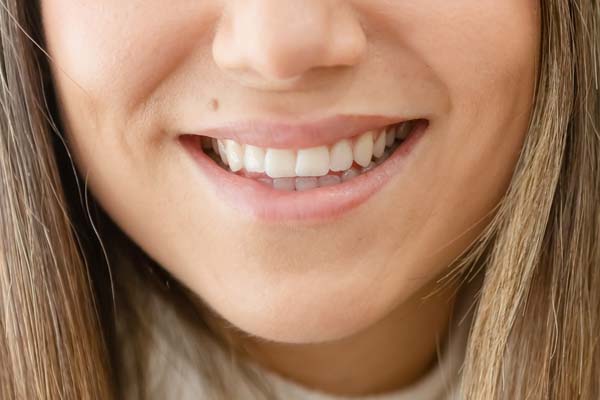 Are There Popular Smile Makeover Options?