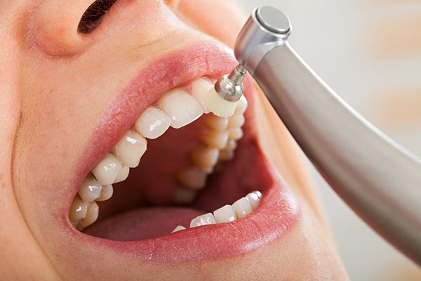 Why Is It Necessary to Get a Dental Cleaning? from Encino Cosmetic & Dental Implants in Encino, CA